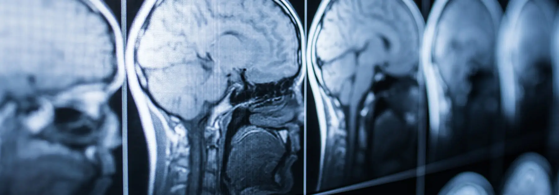 Traumatic Brain Injuries
